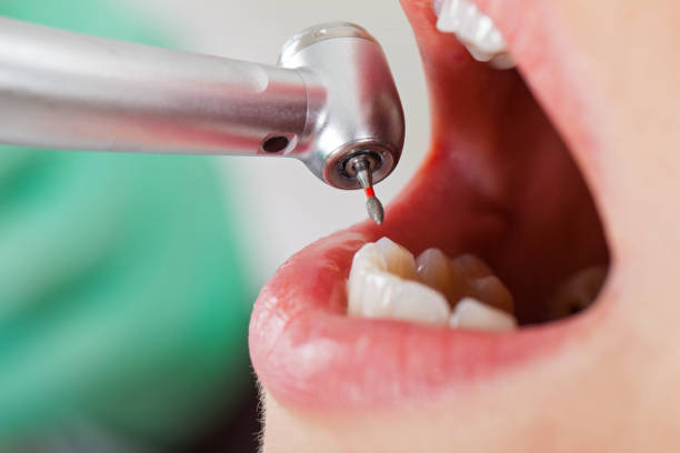 Best Emergency Root Canal Treatment in Keedysville, MD